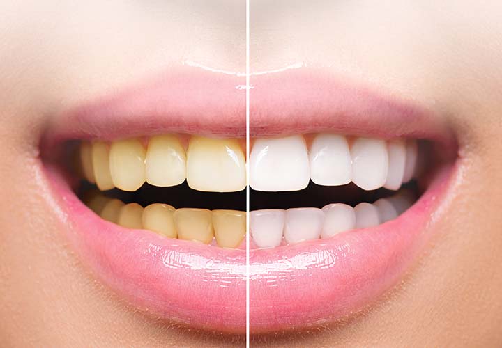 Teeth Whitening | eyeSMILE